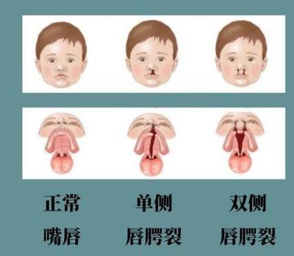口腔微生物與唇腭裂及唇腭裂患者易感疾病有何關聯（一）