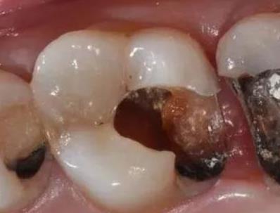 口腔微生物與唇腭裂及唇腭裂患者易感疾病有何關聯（二）